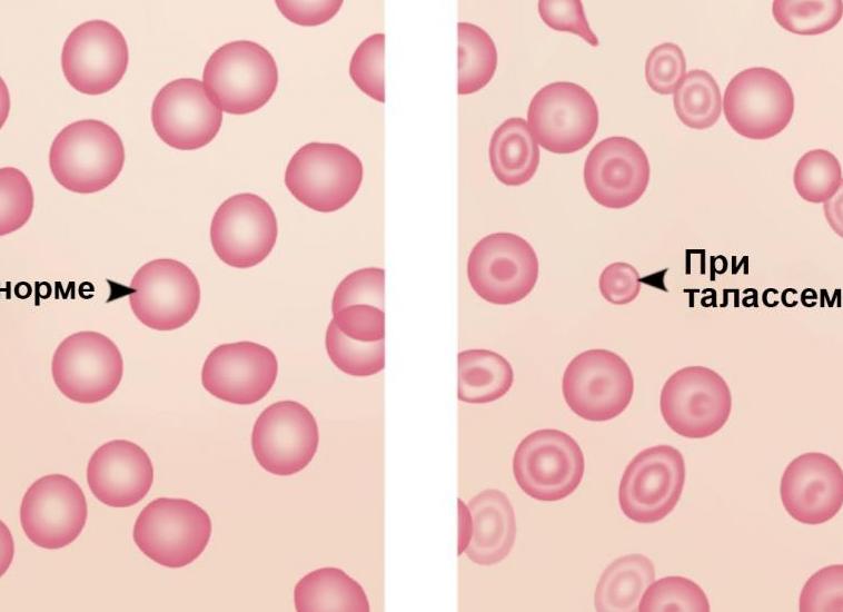 Мишеневидные эритроциты определяются при заболевании