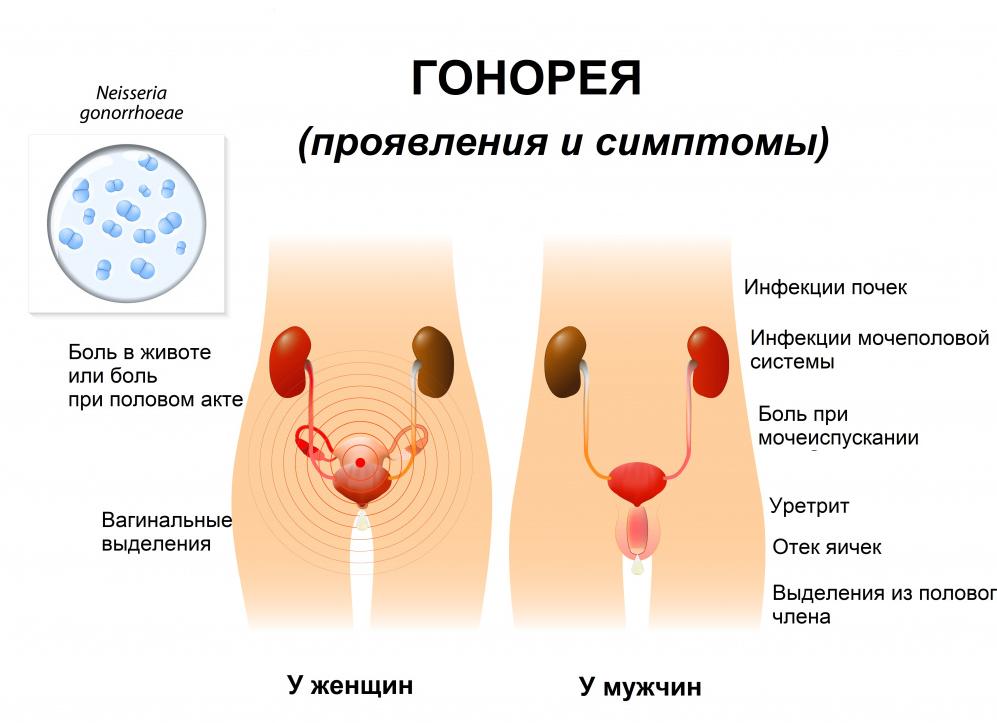 Мазок на гонококки у женщин