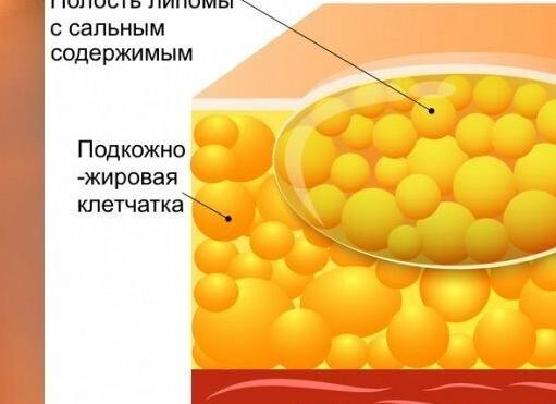Липома молочной железы Липома молочной железы