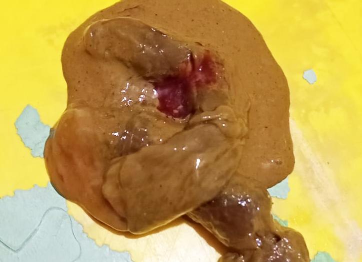 Как выглядит кровь в кале фото Как выглядит кровь в кале фото