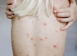 Как проверяют на сифилис Как проверяют на сифилис