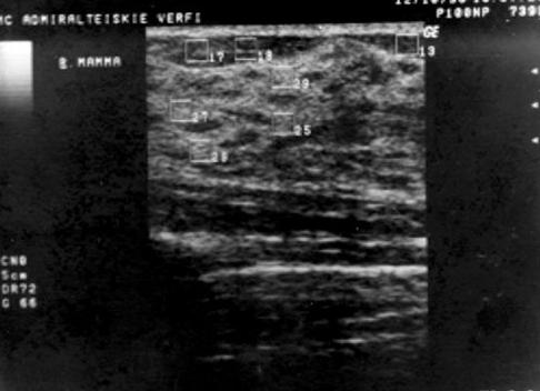Фиброзно кистозная мастопатия узи