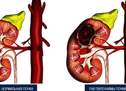 Диффузные изменения в почках