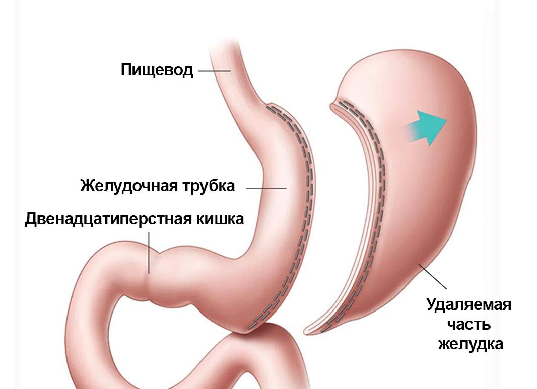 Что такое резекция желудка