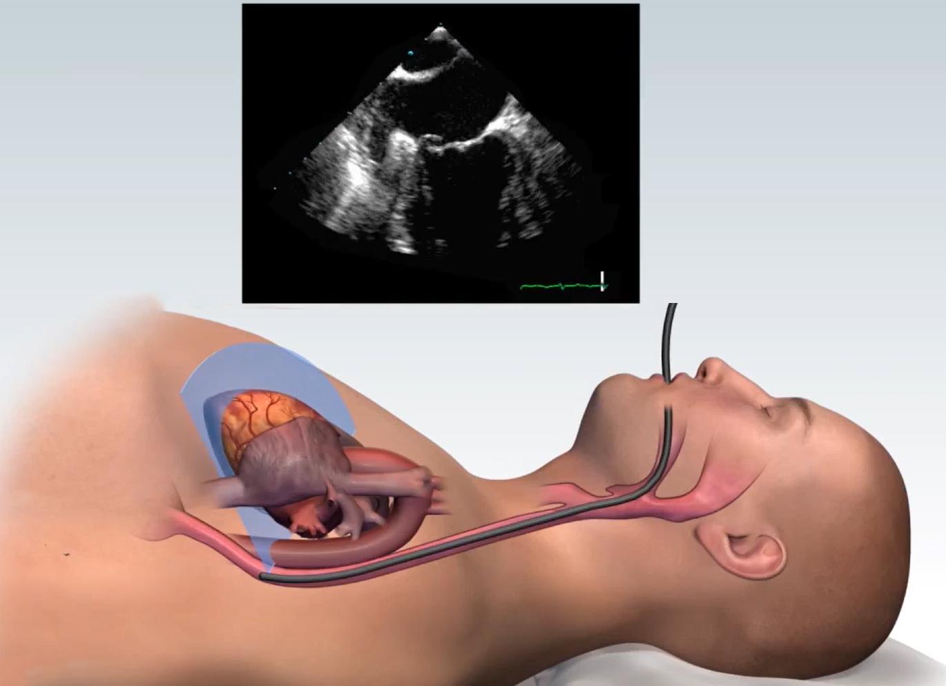 Чреспищеводная эхокардиография что это такое