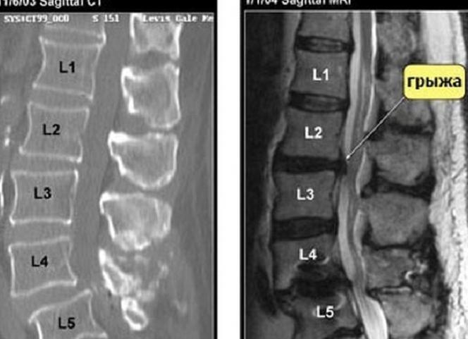 Чем отличается мрт от кт позвоночника и что лучше