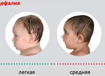 Брахицефалия у детей
