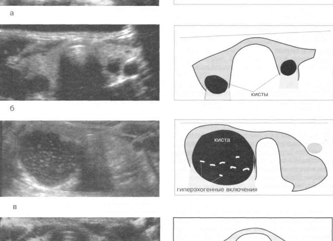 Анэхогенное включение в щитовидной железе что это
