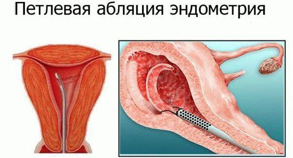 Гиперплазия эндометрия в менопаузе