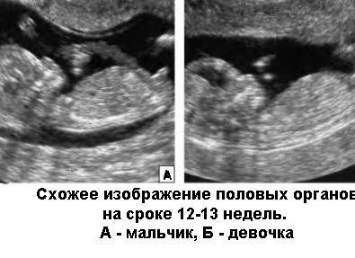 Можно ли в 12 недель определить пол ребенка по узи скрининг