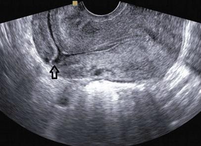 Когда после кесарева делать узи Когда после кесарева делать узи