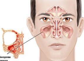 Кисты обеих верхнечелюстных пазух
