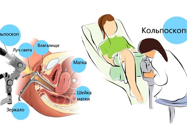 Хромокольпоскопия с биопсией