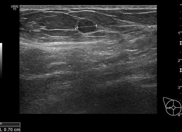 Гипоэхогенное образование неоднородное