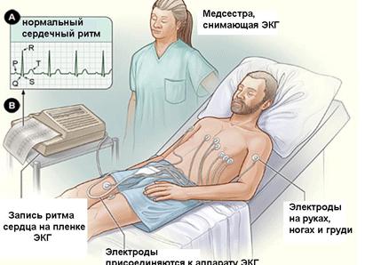 Экг сердца что такое