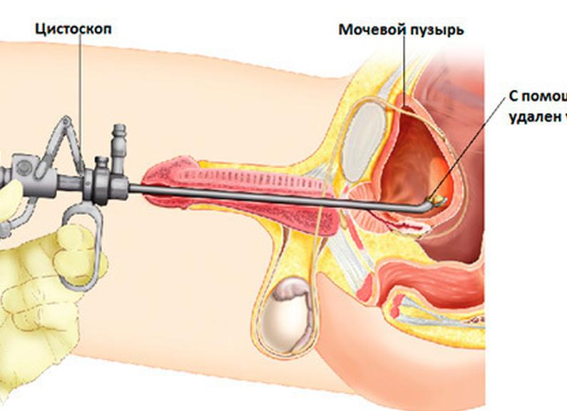 Больно ли брать мазок из уретры у мужчин Больно ли брать мазок из уретры у мужчин