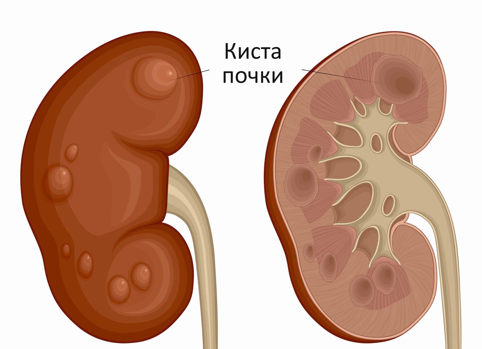 Анэхогенное образование в почке