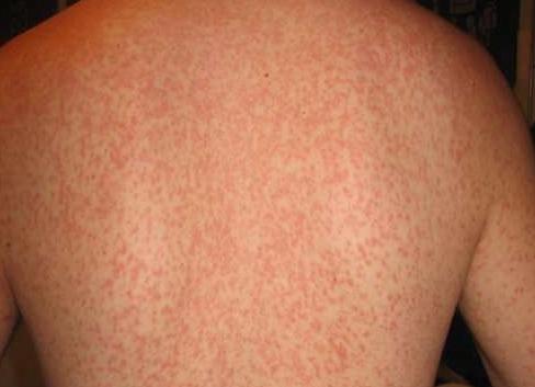 Анализ эпштейна барра что это такое