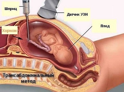 Кровь на патологию плода