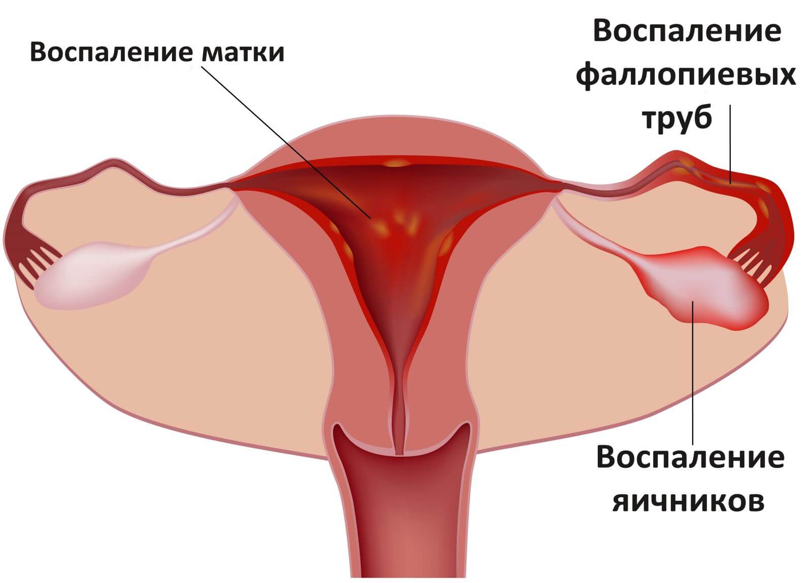 Левосторонний аднексит что это такое