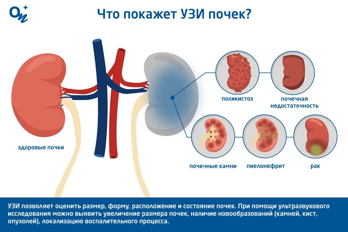 Можно ли пить перед узи почек
