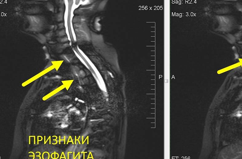 Мрт пищевода что показывает