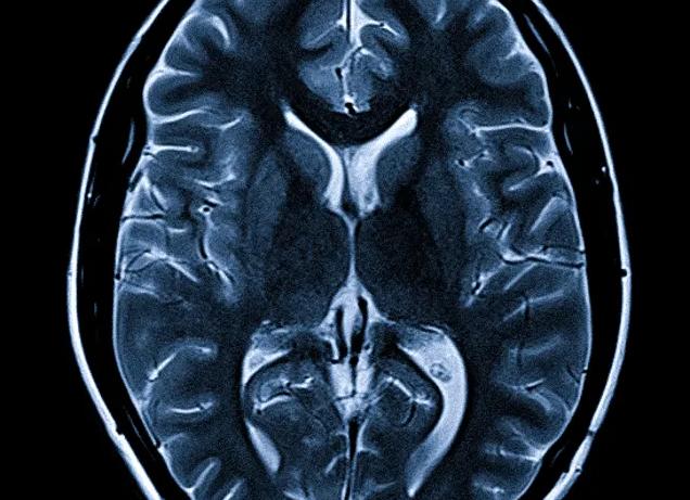 Мрт гипофиза при повышенном пролактине