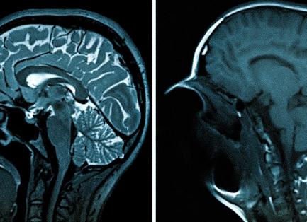 Можно ли делать мрт со штифтом в зубе