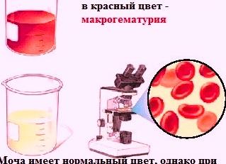 Макрогематурия что это такое