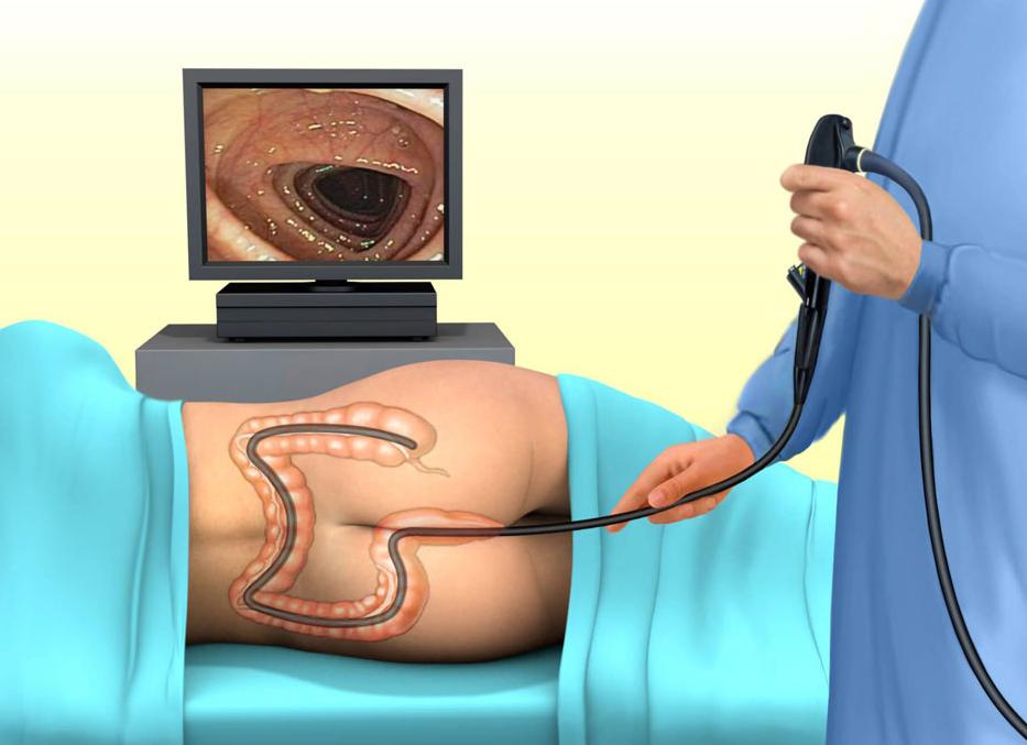 Колоноскопия что такое