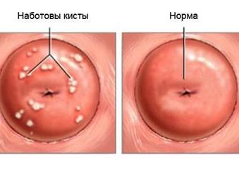Киста наботовой железы