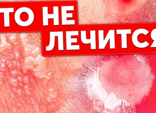 Генитальный герпес это