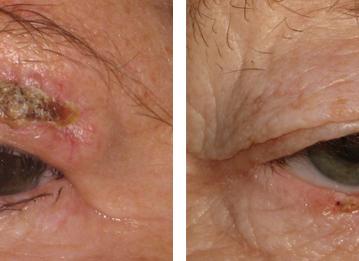 Фото рак века