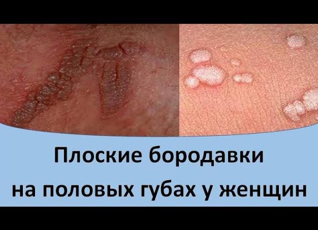 Фото папилломы на женских органах