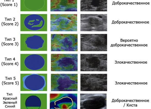 Эластография молочных желез что это такое