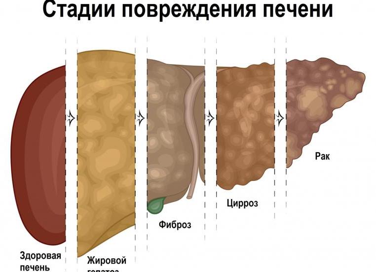 Цирроз печени как выглядит на узи