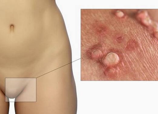 Что такое папилломавирус