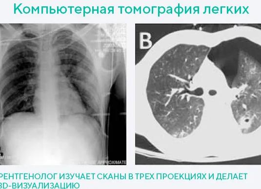 Что лучше кт легких или рентген