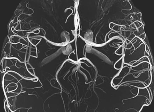 Ангиография мрт сосудов головного мозга