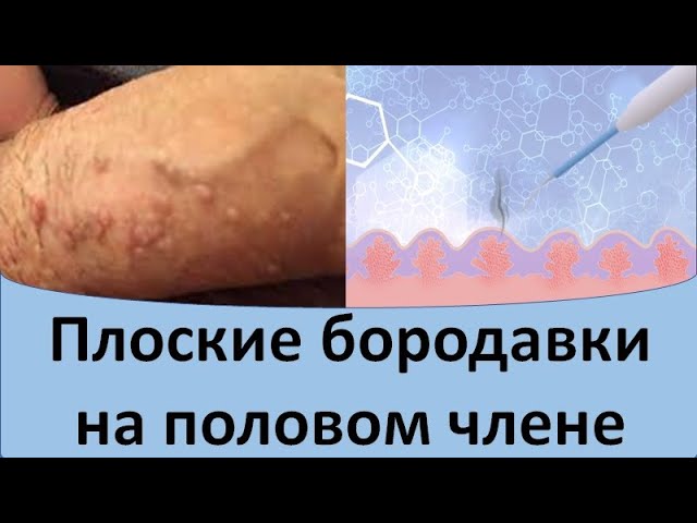 Как лечить папилломы на половых органах