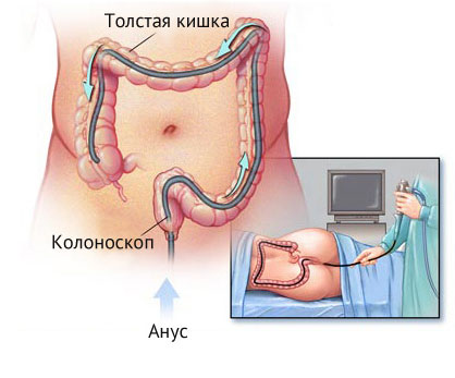Кольпоскопия кишечника что это
