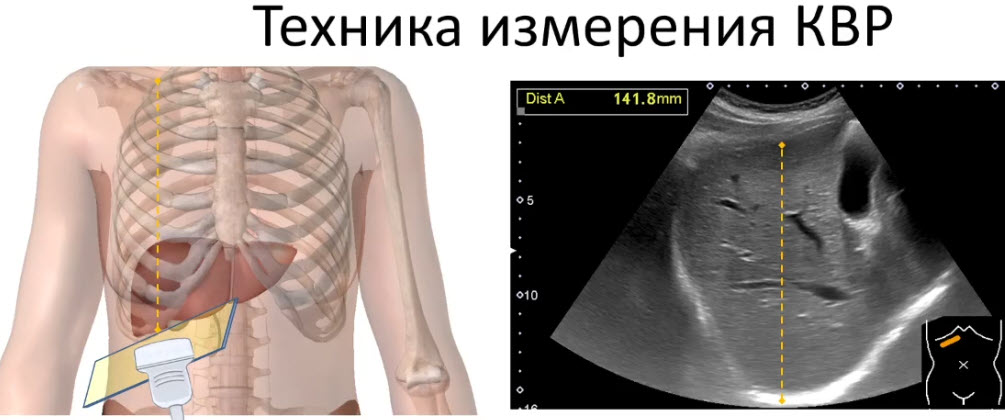 Квр печени расшифровка