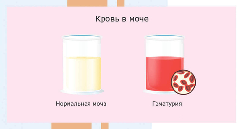 Моча розового цвета у женщин причины