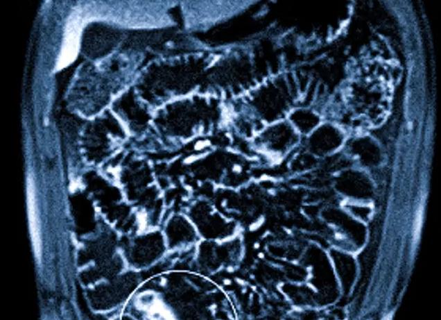 Мрт кишечника у женщин что показывает
