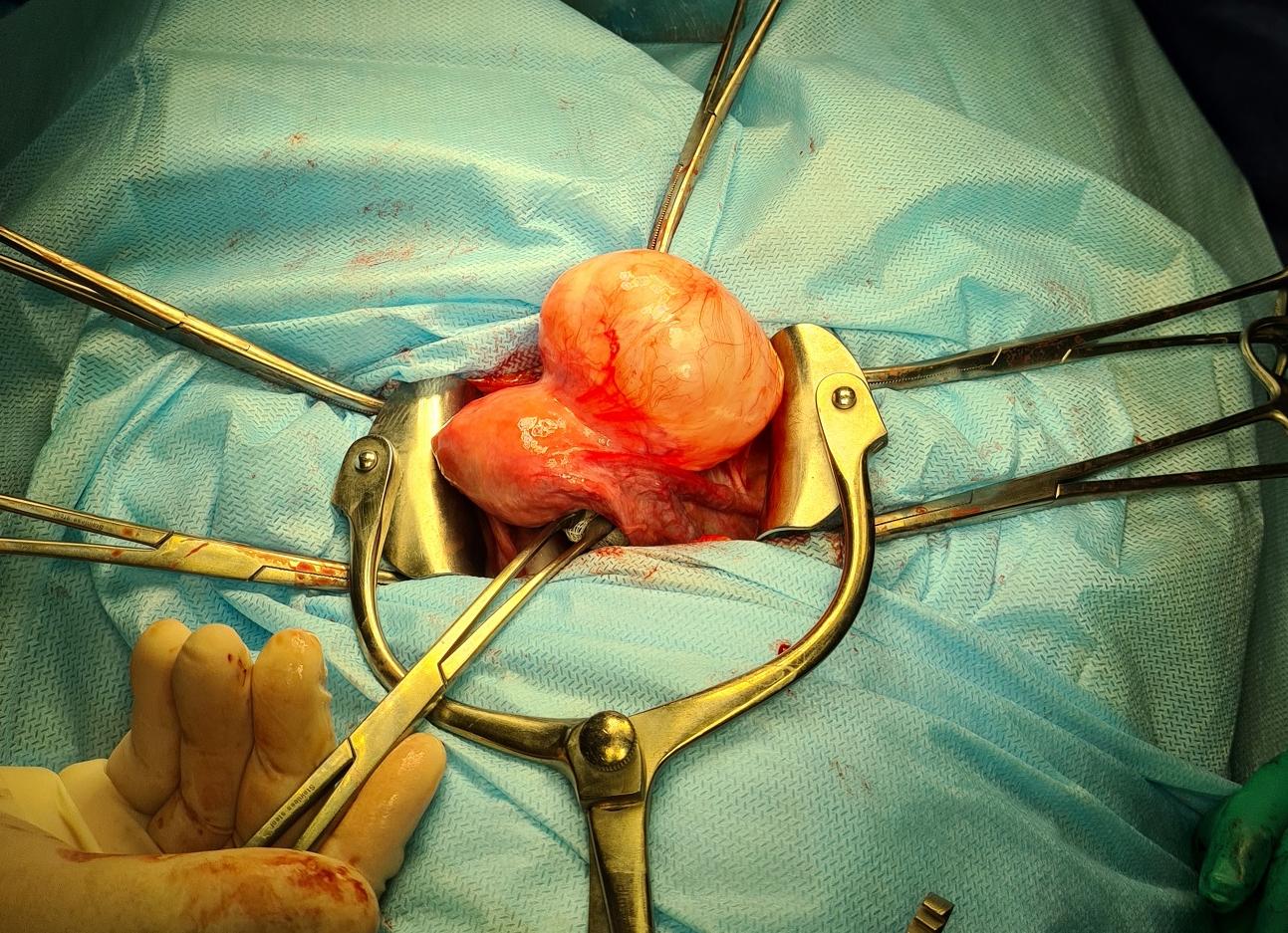 Матка после кесарева сечения