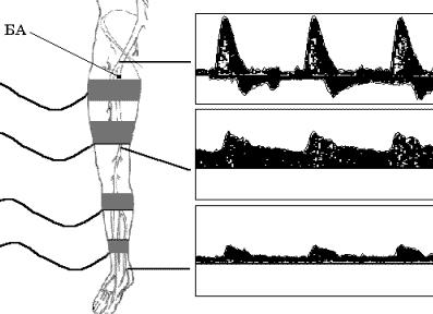 Кровоток магистральный что это