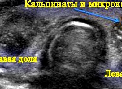 Кальцинаты в щитовидной железе