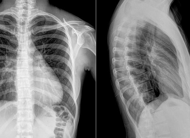 Что показывает рентген грудного отдела позвоночника в двух проекциях