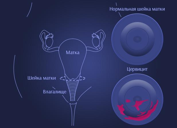 Цервикоз что это