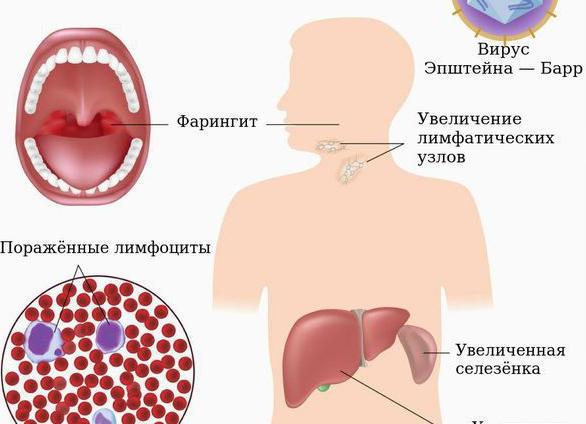Атипичные мононуклеары характерные для инфекционного мононуклеоза